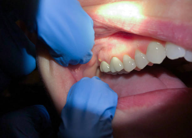 Best Emergency Wisdom Teeth Removal in Overlea, MD